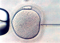 ICSI - Intracytoplasmatická injekce spermie