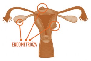 Endometrióza
