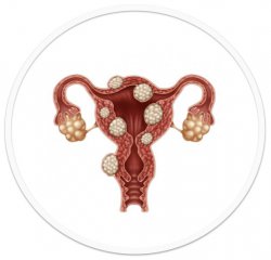 Endometrióza.001